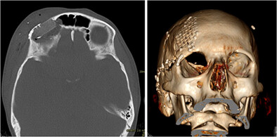 Supraorbital Rim and Roof Reconstruction with Vascularized Fascia Lata and Autogenous Rib Graft