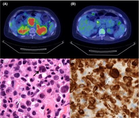 Non-Hodgkin lymphoma presenting as acute pancreatitis: A rare occurrence