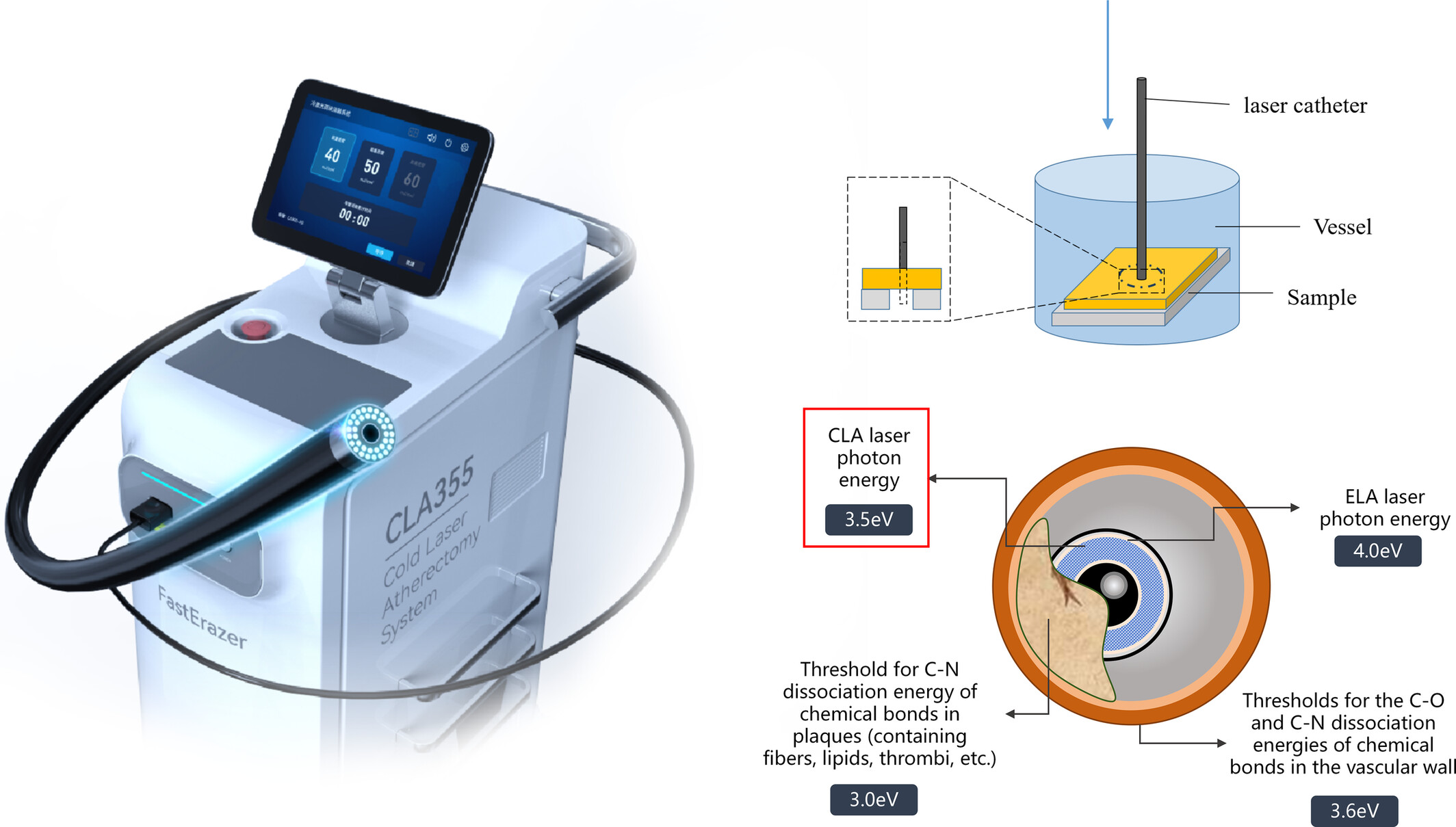 An in vitro feasibility study of 355 nm laser atherectomy for the treatment of peripheral atherosclerotic lesions