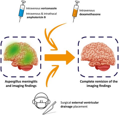Promising effects of corticosteroid treatment in combination with antifungal agents in a patient with Aspergillus meningitis