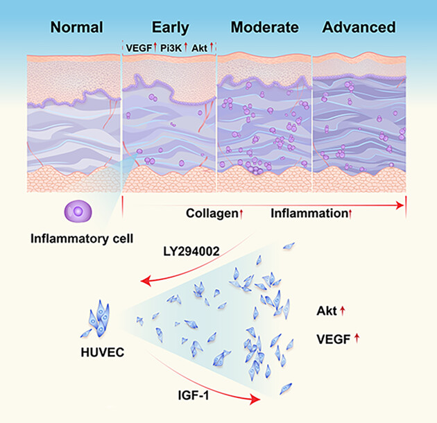 Expression and correlation of the Pi3k/Akt pathway and VEGF in oral submucous fibrosis