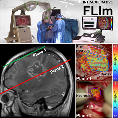 Real-time augmented reality for delineation of surgical margins during neurosurgery using autofluorescence lifetime contrast