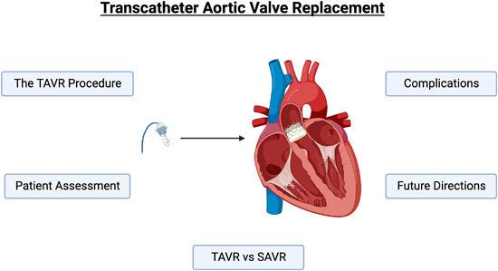 Transcatheter aortic valve replacement: Past, present, and future