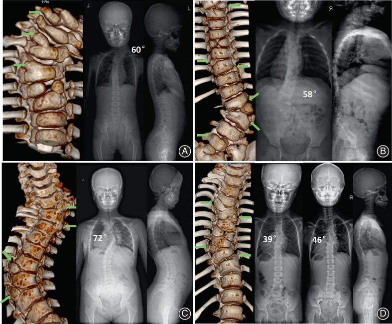 Multiple Hemivertebrae: The Natural History and Treatment of 50 Patients