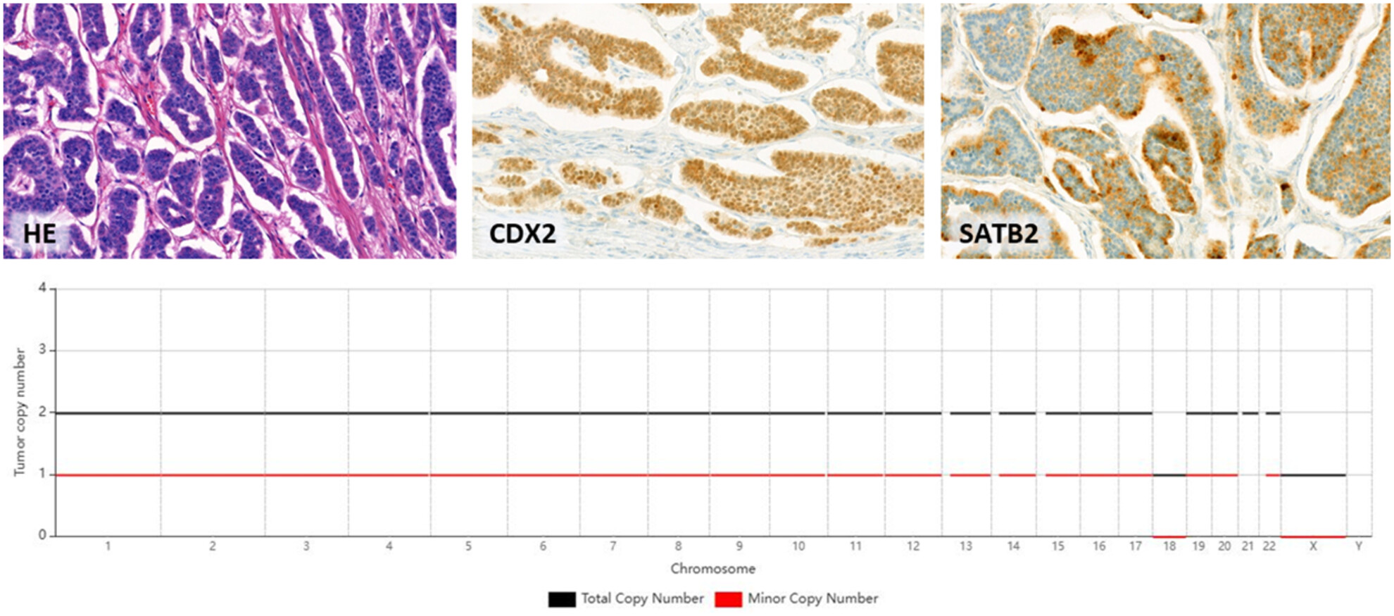 Comprehensive genomic profiling and immunohistochemical analysis of prepubertal-type testicular neuroendocrine tumours in postpubertal patients reveal a possible relationship with small intestinal neuroendocrine tumours