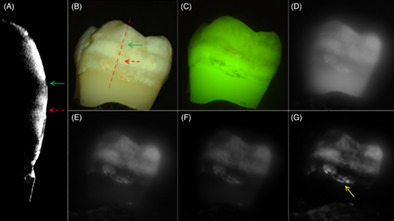 High contrast imaging of dental fluorosis in the short wavelength infrared