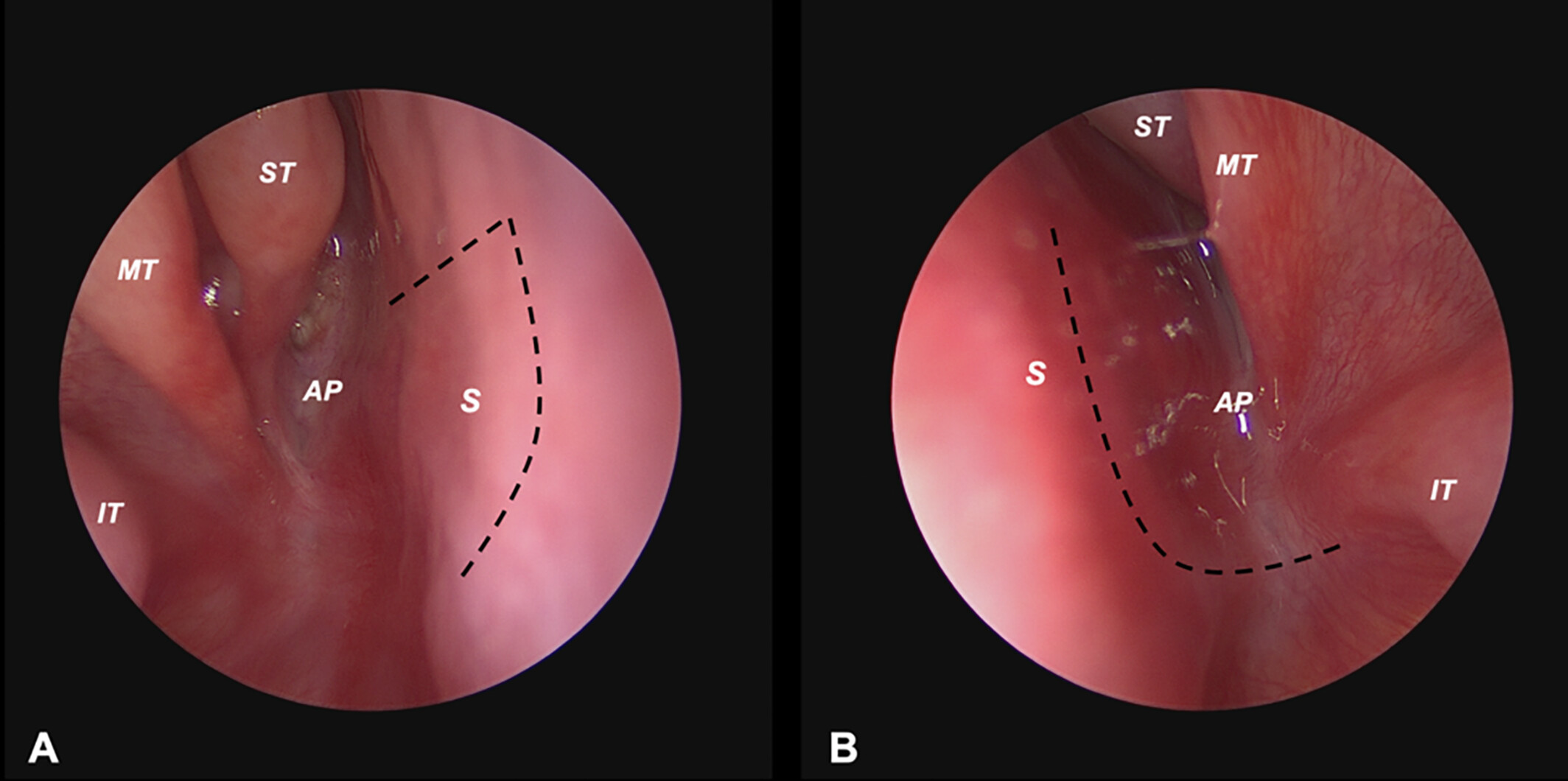 A Modified Single-Stage Endoscopic Repair for Bilateral Choanal Atresia
