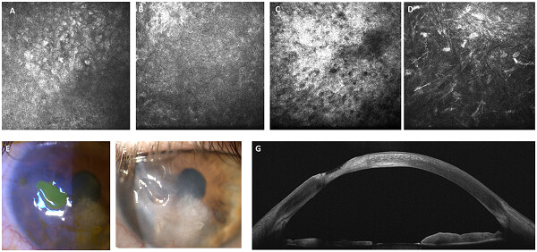 In vivo microscopic and optical coherence tomography classification of neurotrophic keratopathy