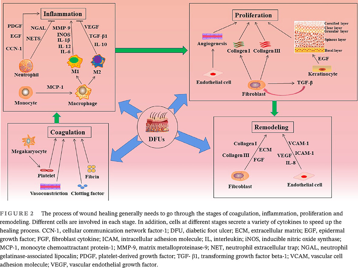 Mechanisms of diabetic foot ulceration: A review 糖尿病足溃疡发生机制综述