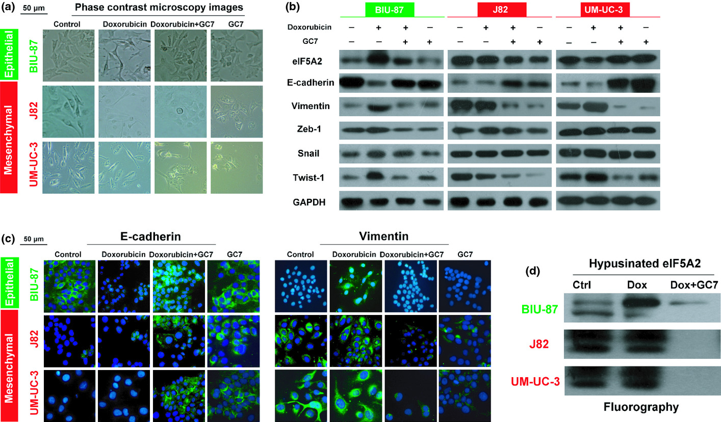 N1-guanyl-1,7-diaminoheptane sensitizes bladder cancer cells to doxorubicin by preventing epithelial–mesenchymal transition through inhibition of eukaryotic translation initiation factor 5A2 activation