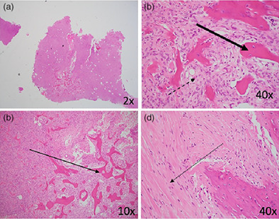 Clinical, radiological and pathological outcomes following treatment of primary giant cell tumour of bone with Denosumab
