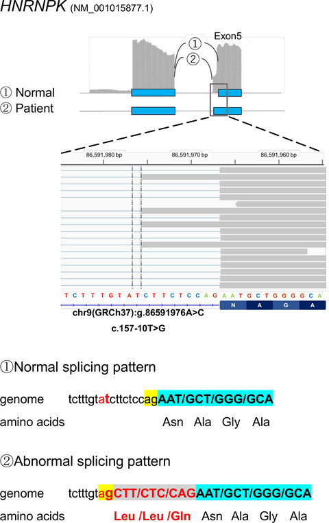 Diagnostic utility of integrated analysis of exome and transcriptome: Successful diagnosis of Au-Kline syndrome in a patient with submucous cleft palate, scaphocephaly, and intellectual disabilities
