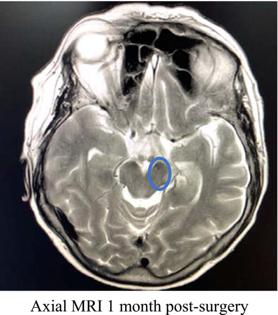 Spontaneous intracranial hypotension complicated by unilateral subdural hematoma, coma, and the rare Kernohan's notch phenomenon