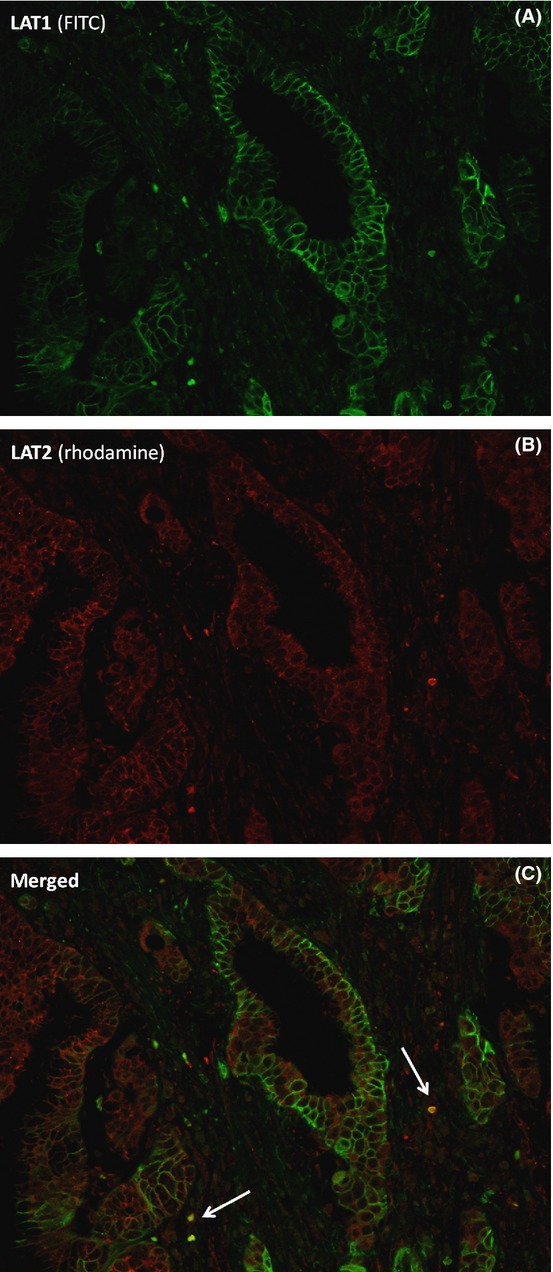 High expression of L-type amino acid transporter 1 as a prognostic marker in bile duct adenocarcinomas