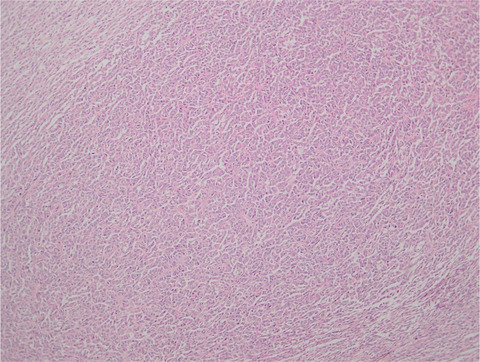Adult-type granulosa cell tumor: An unusual testicular tumor