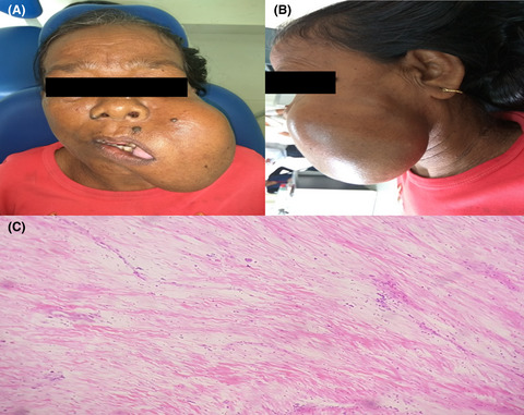 A long-standing case of desmoplastic fibroblastoma of the face