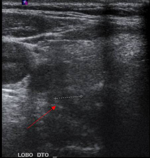 A reversible case of rapidly progressive dementia—Hypercalcemia due to hyperparathyroidism