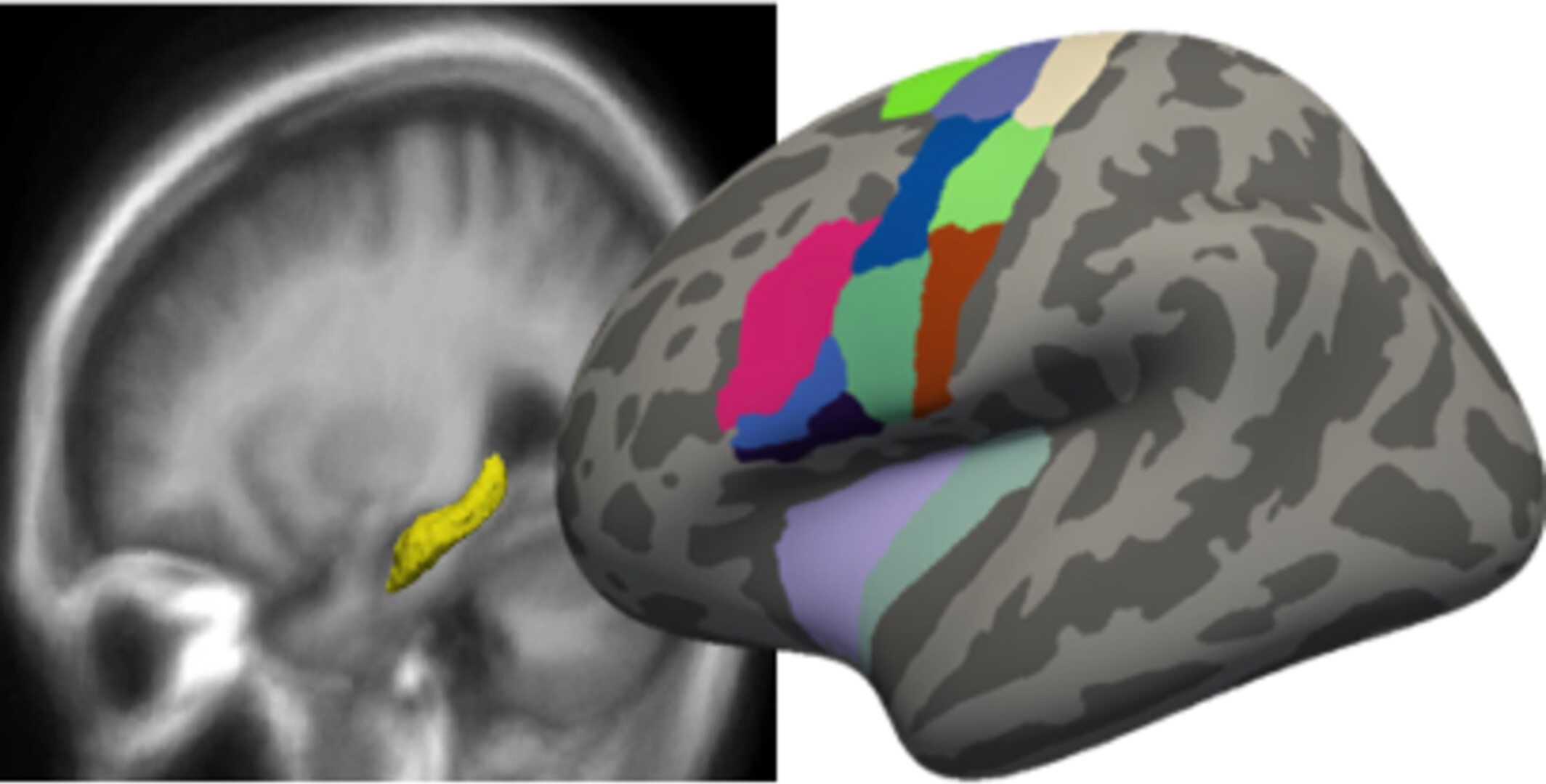 Age-Associated Cortical Thinning in Speech Motor Regions Precedes Hippocampal Decline: Implications for Alzheimer's Disease