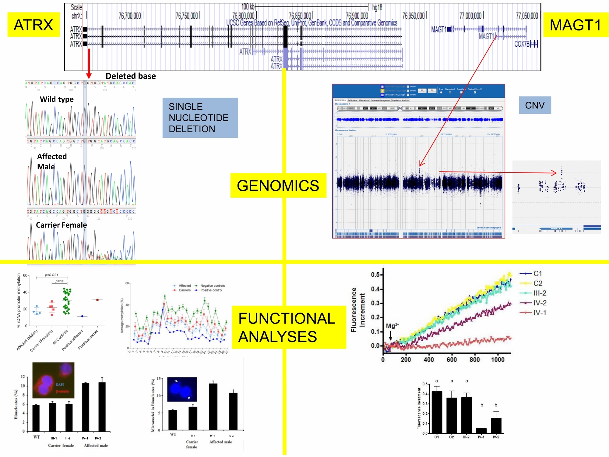 Variant ATRX Syndrome with Dysfunction of ATRX and MAGT1 Genes
