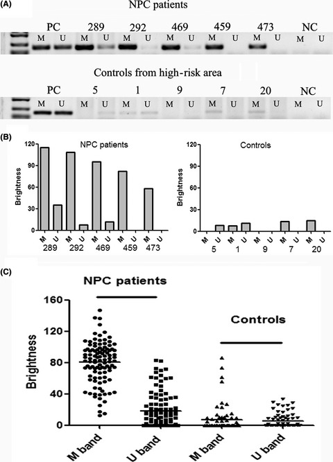 Detection of methylation status of Epstein-Barr virus DNA C promoter in the diagnosis of nasopharyngeal carcinoma