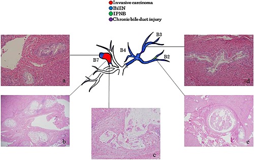 Pathological spectrum of bile duct lesions from chronic bile duct injury to invasive cholangiocarcinoma corresponding to bile duct imaging findings of occupational cholangiocarcinoma