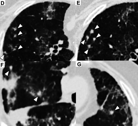Multiple nodular lesions following Pneumocystis pneumonia in a non-HIV immunocompromised patient