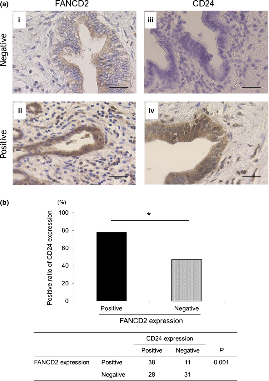 BRCA/Fanconi anemia pathway implicates chemoresistance to gemcitabine in biliary tract cancer