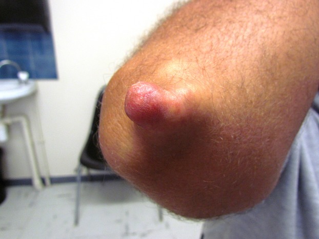 Familial hypercholesterolemia presenting with multiple nodules of the hands and elbow