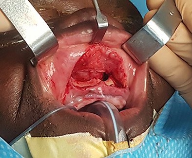 Sublabial bioactive glass implantation for the management of primary atrophic rhinitis and empty nose syndrome: Operative technique
