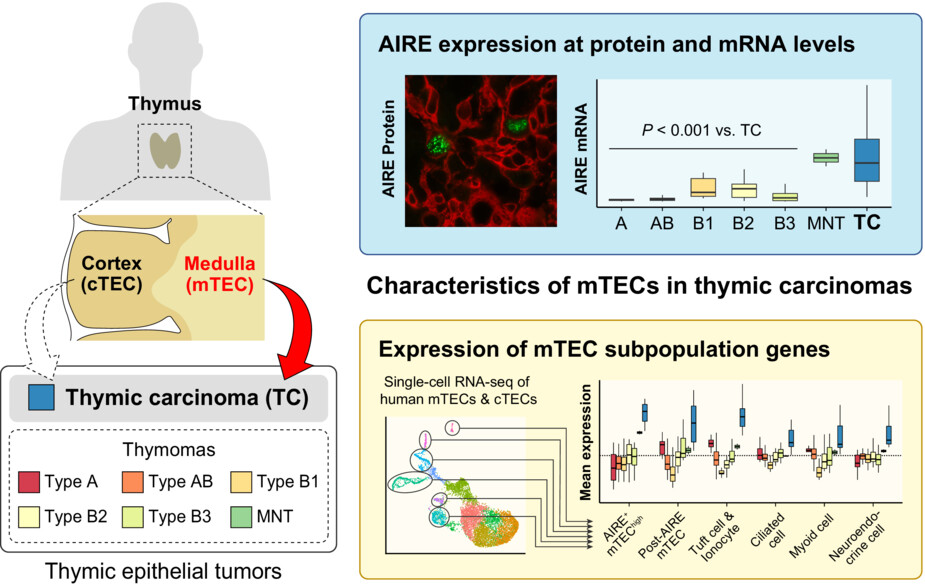 AIRE illuminates the feature of medullary thymic epithelial cells in thymic carcinoma
