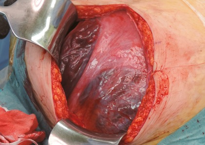 Managing cesarean section in a patient with rotated uterus due to a large myoma