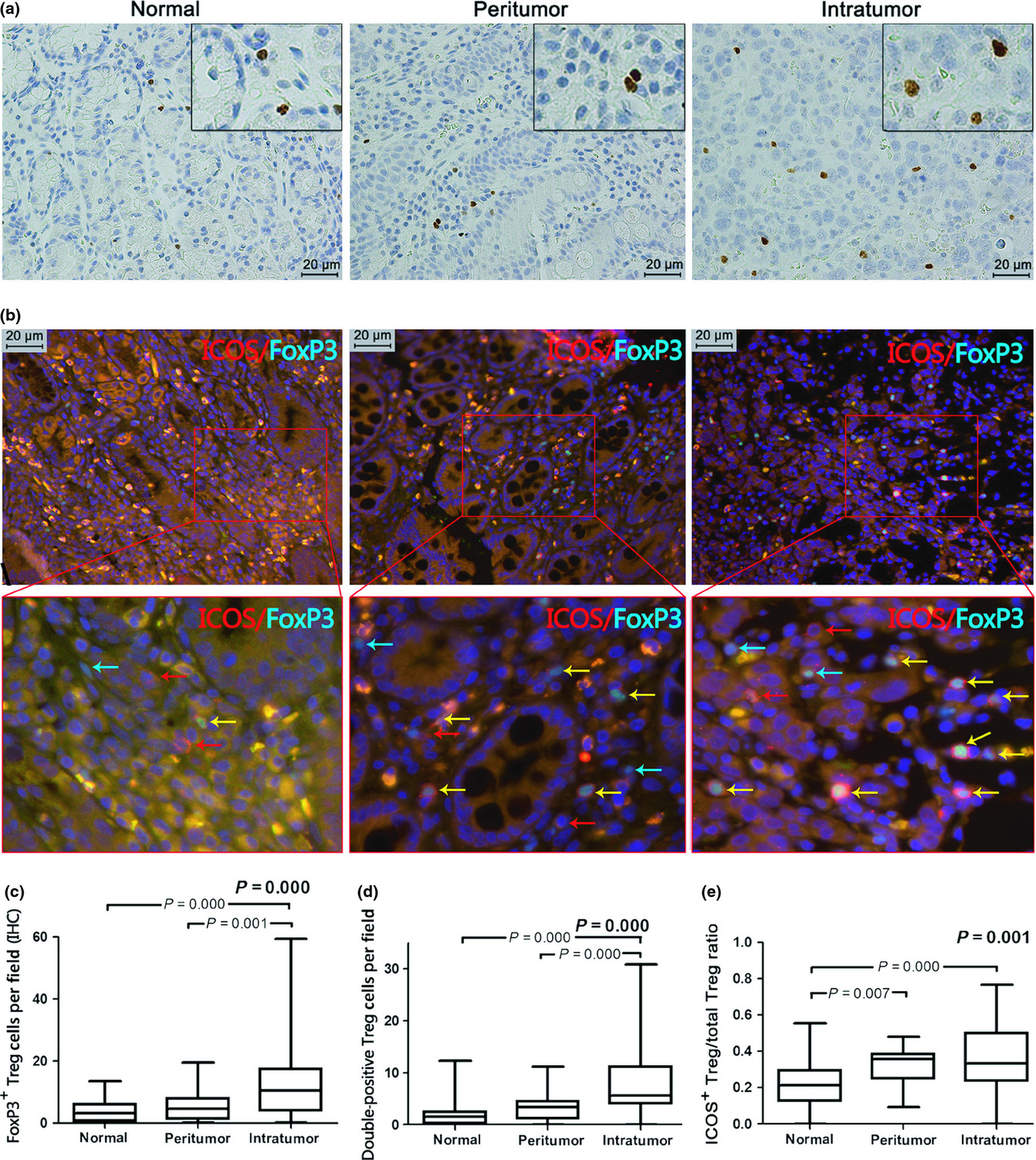 Role of plasmacytoid dendritic cells and inducible costimulator-positive regulatory T cells in the immunosuppression microenvironment of gastric cancer