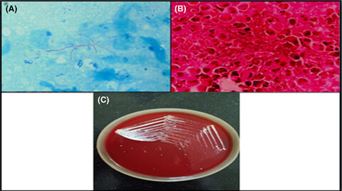 Cytology of primary nocardiosis of the lymph node: A rare report
