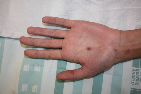 Palmar rash in a teenager: more than meets the eye