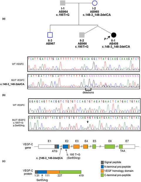 Investigation on the role of biallelic variants in VEGF-C found in a patient affected by Milroy-like lymphedema