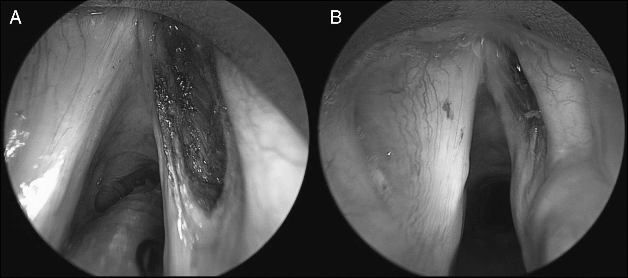 Airway and Voice Outcomes After Thyroarytenoid Myomectomy for Bilateral Vocal Fold Immobility