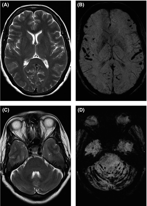 Superficial siderosis due to filum terminale tumor: An uncommon cause of cranial nerve dysfunction