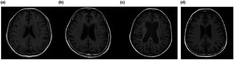 Adult-onset Krabbe disease due to a homozygous GALC mutation without abnormal signals on an MRI in a consanguineous family: A case report