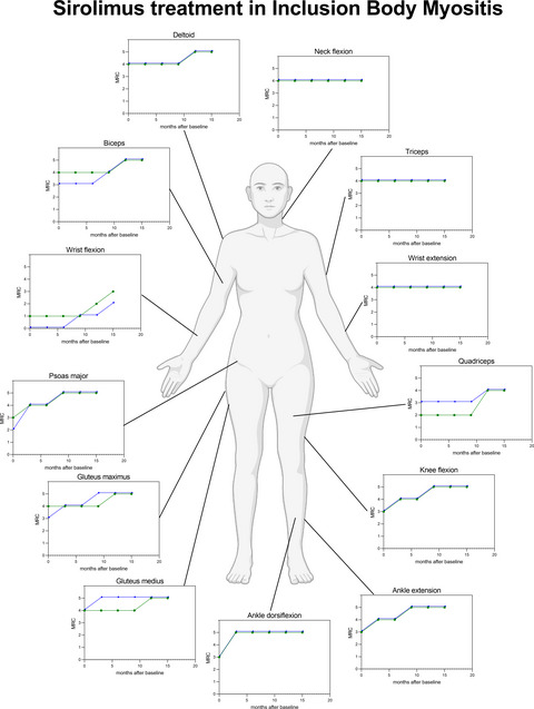 Sirolimus leads to rapid and sustained clinical improvement of motor deficits in a patient with inclusion body myositis