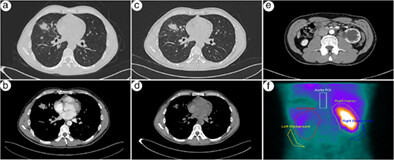 Ureteral metastasis from pulmonary adenocarcinoma: A case report and literature review