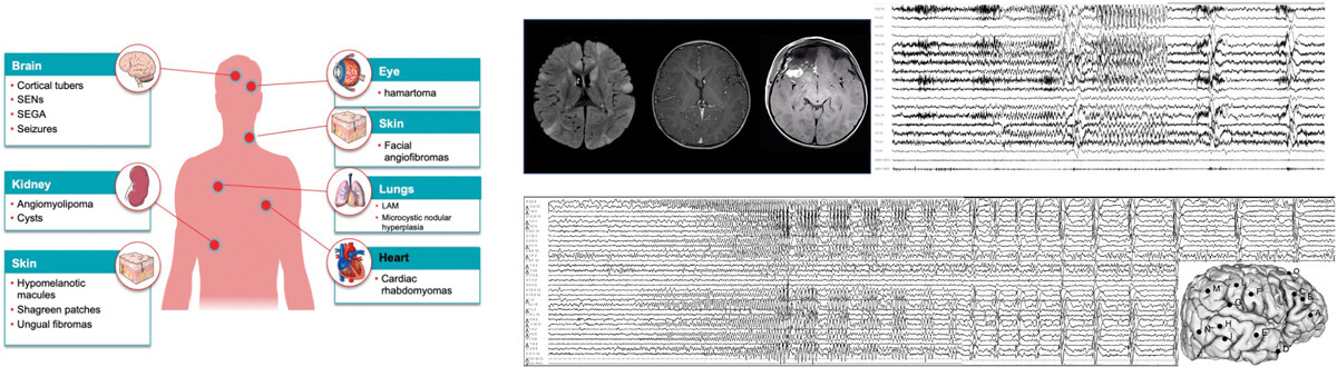 Current role of surgery for tuberous sclerosis complex-associated epilepsy