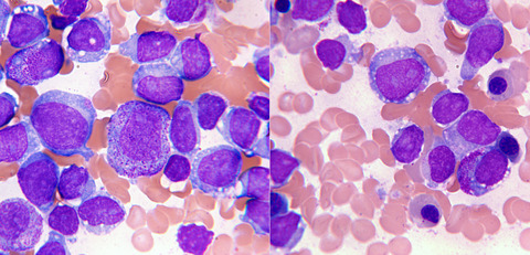 Case report of granular acute lymphoblastic leukemia and review of the literature
