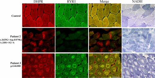 RyR1 Deficiency in Congenital Myopathies Disrupts Excitation–Contraction Coupling