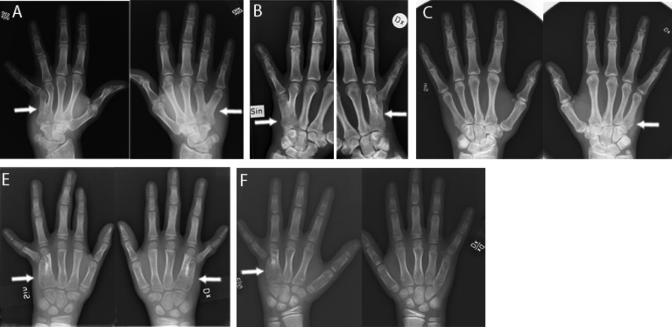 Identification of three novel FGF16 mutations in X-linked recessive fusion of the fourth and fifth metacarpals and possible correlation with heart disease