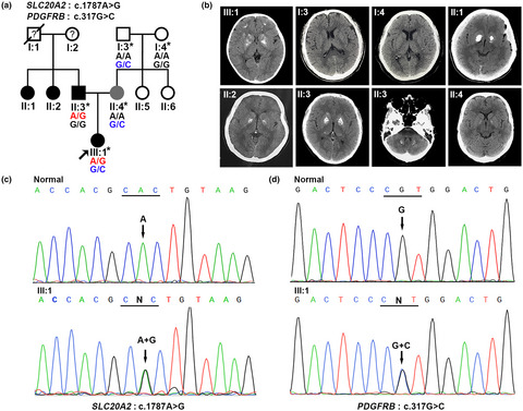 Severe brain calcification and migraine headache caused by SLC20A2 and PDGFRB heterozygous mutations in a five-year-old Chinese girl