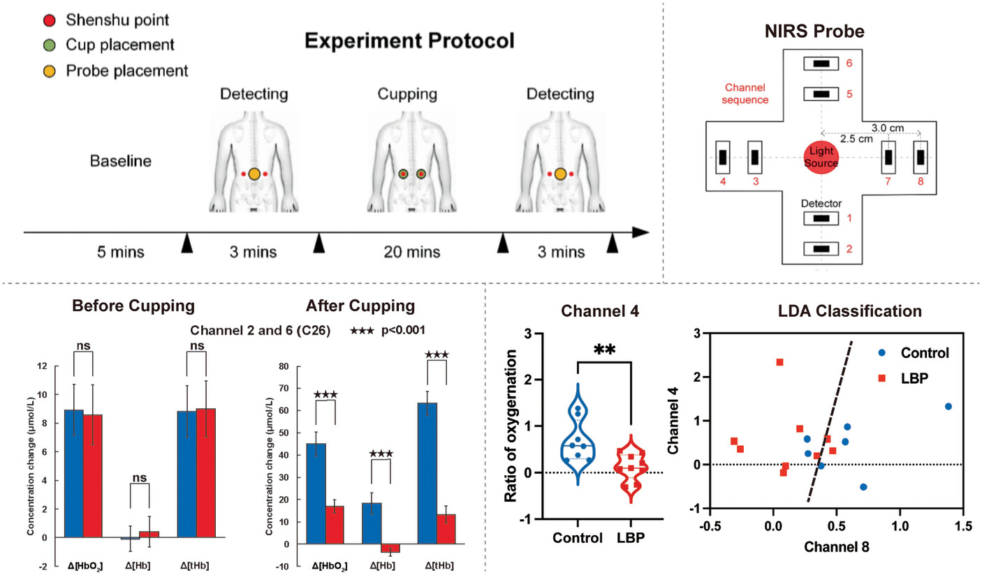 Noninvasive Assessing Low Back Pain by a Novel Near-Infrared Spectroscopy Flexible Probe With the Aid of Cupping Protocol