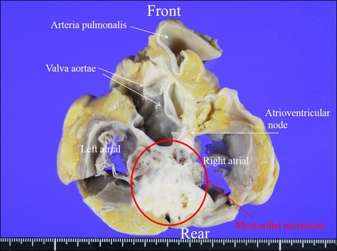 A case of gingival cancer with pulmonary metastases that developed complete atrioventricular block and ventricular fibrillation as a result of myocardial metastases