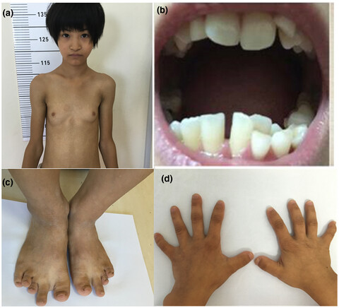 SHORT syndrome in two Chinese girls: A case report and review of the literature