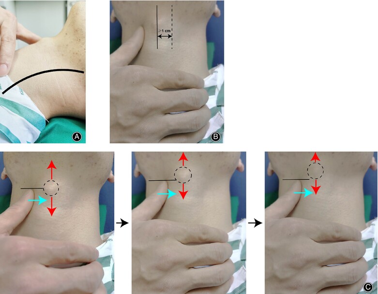 Modified Tracheal Traction Exercise Reduces the Incidence of Dysphagia in Patients with Multilevel Anterior Cervical Discectomy and Fusion