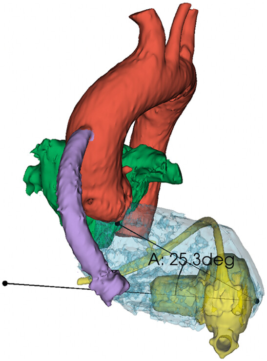 Comparing left ventricular assist device inflow cannula angle between median sternotomy and thoracotomy using 3D reconstructions